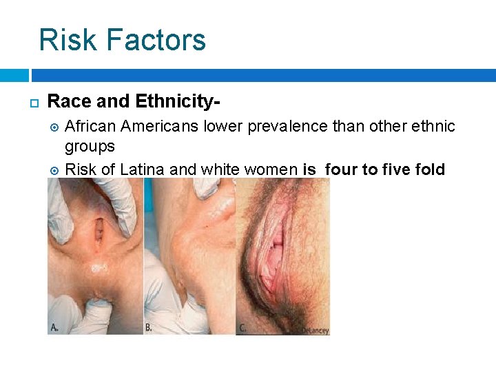 Risk Factors Race and Ethnicity. African Americans lower prevalence than other ethnic groups Risk