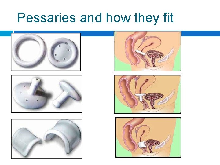 Pessaries and how they fit 