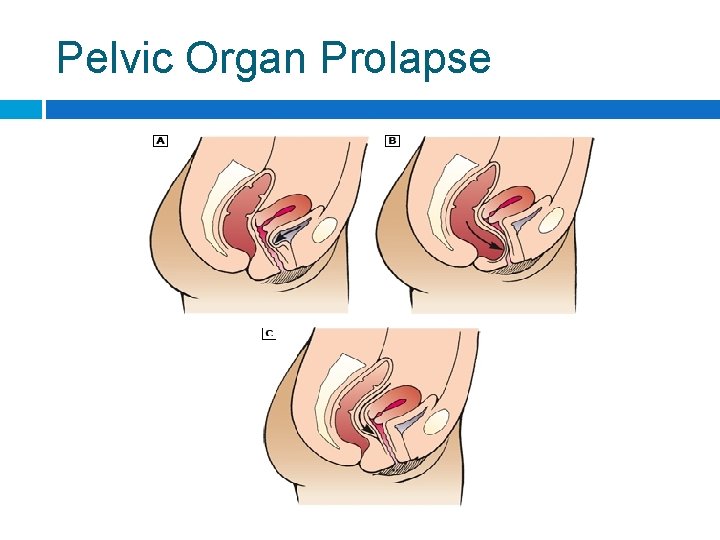 Pelvic Organ Prolapse 