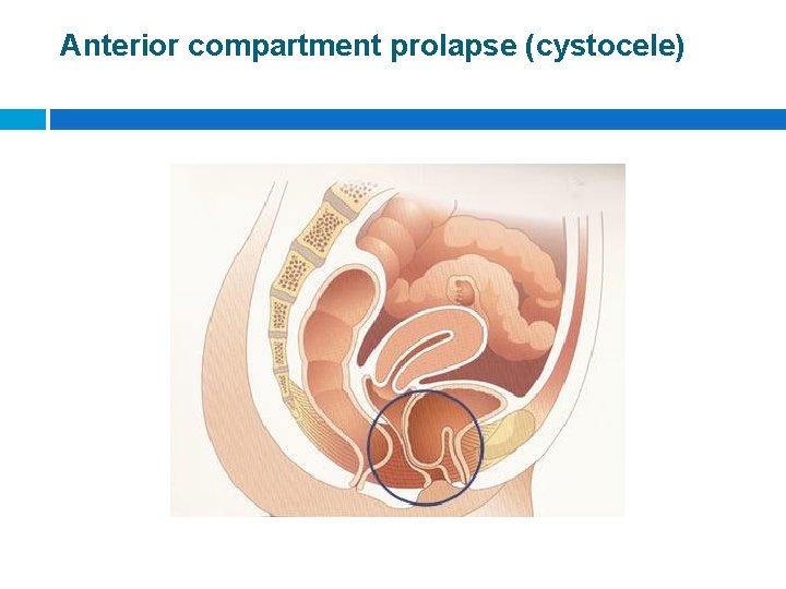 Anterior compartment prolapse (cystocele) 