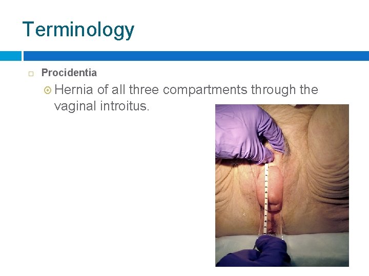 Terminology Procidentia Hernia of all three compartments through the vaginal introitus. 