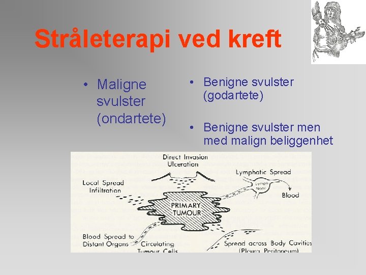 Stråleterapi ved kreft • Maligne svulster (ondartete) • Benigne svulster (godartete) • Benigne svulster