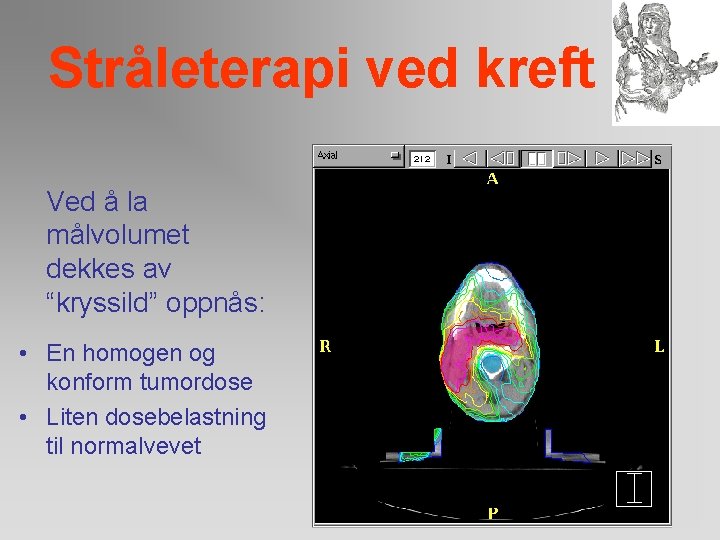 Stråleterapi ved kreft Ved å la målvolumet dekkes av “kryssild” oppnås: • En homogen