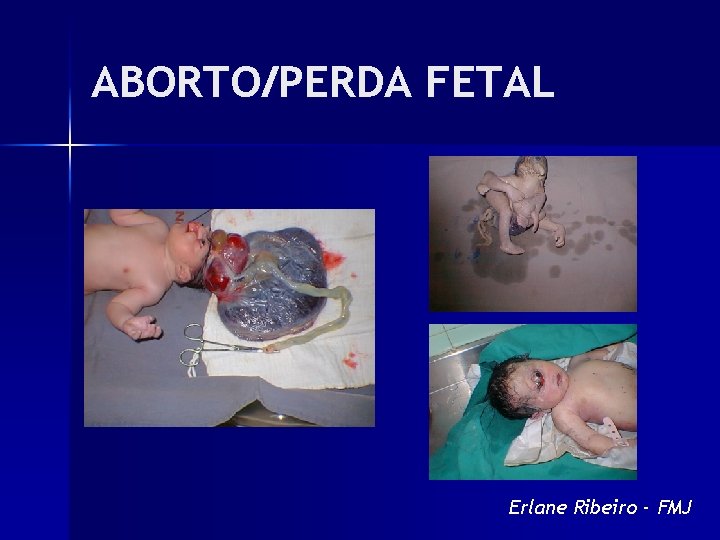 ABORTO/PERDA FETAL Erlane Ribeiro - FMJ 