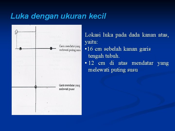 Luka dengan ukuran kecil Lokasi luka pada dada kanan atas, yaitu: • 16 cm Luka dengan ukuran kecil Lokasi luka pada dada kanan atas, yaitu: • 16 cm