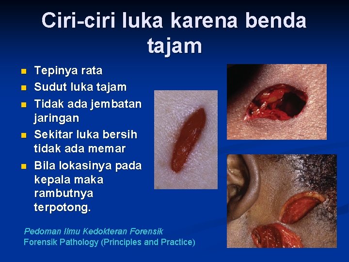 Ciri-ciri luka karena benda tajam n n n Tepinya rata Sudut luka tajam Tidak Ciri-ciri luka karena benda tajam n n n Tepinya rata Sudut luka tajam Tidak