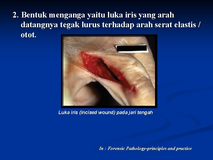 2. Bentuk menganga yaitu luka iris yang arah datangnya tegak lurus terhadap arah serat 2. Bentuk menganga yaitu luka iris yang arah datangnya tegak lurus terhadap arah serat