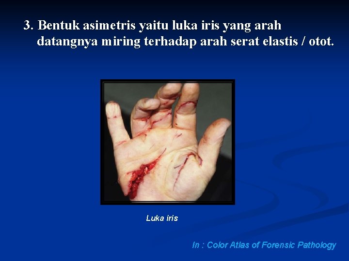 3. Bentuk asimetris yaitu luka iris yang arah datangnya miring terhadap arah serat elastis 3. Bentuk asimetris yaitu luka iris yang arah datangnya miring terhadap arah serat elastis