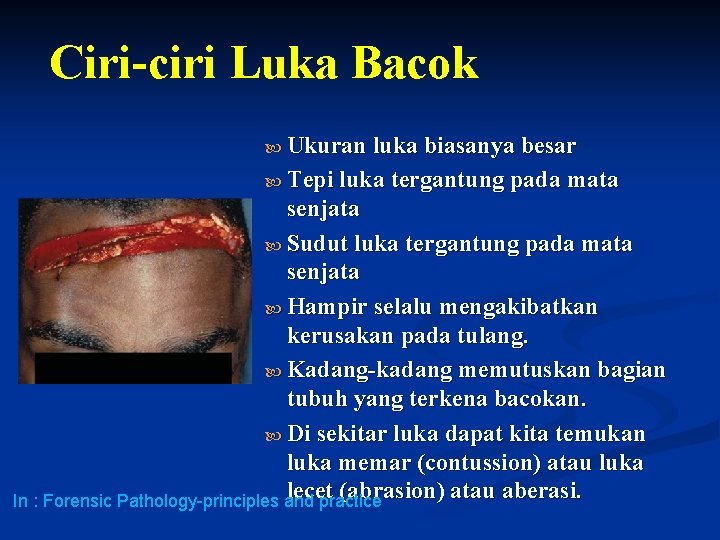 Ciri-ciri Luka Bacok Ukuran luka biasanya besar Tepi luka tergantung pada mata senjata Sudut Ciri-ciri Luka Bacok Ukuran luka biasanya besar Tepi luka tergantung pada mata senjata Sudut