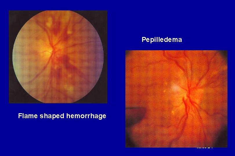 Pepilledema Flame shaped hemorrhage slide 24 