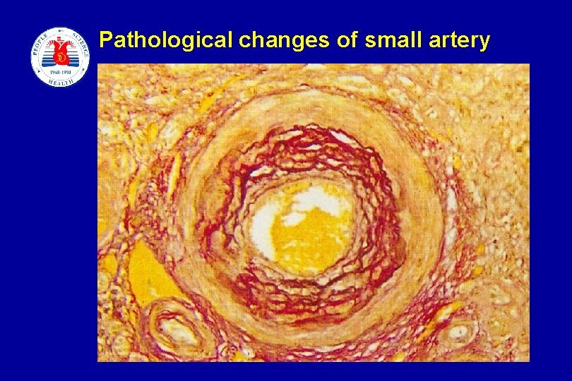 Pathological changes of small artery slide 8 