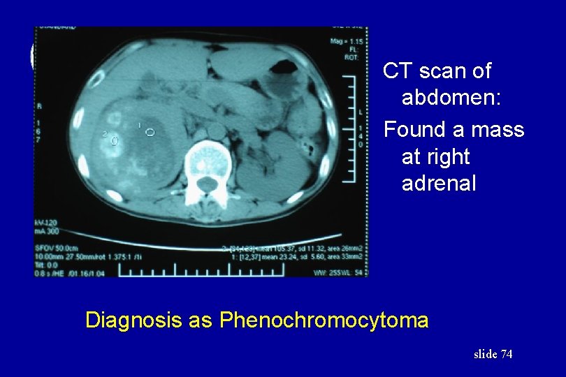 CT scan of abdomen: Found a mass at right adrenal Diagnosis as Phenochromocytoma slide