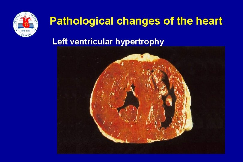 Pathological changes of the heart Left ventricular hypertrophy slide 9 