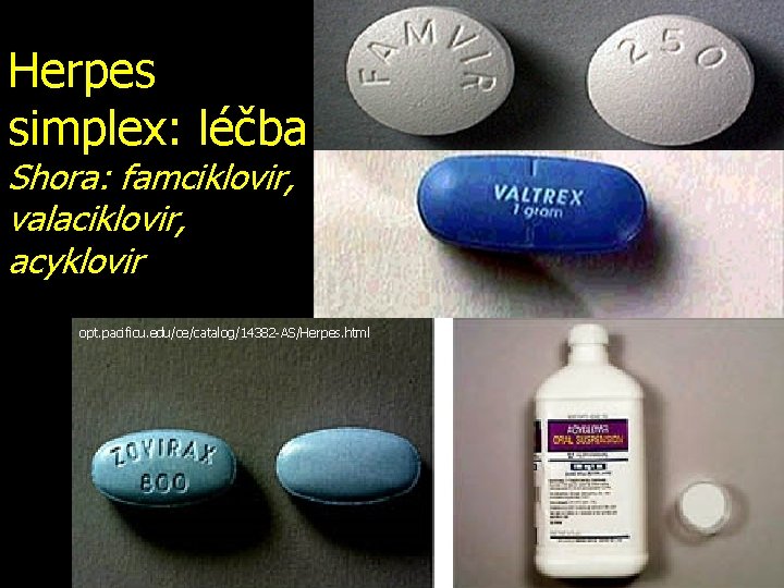 Herpes simplex: léčba Shora: famciklovir, valaciklovir, acyklovir opt. pacificu. edu/ce/catalog/14382 -AS/Herpes. html 