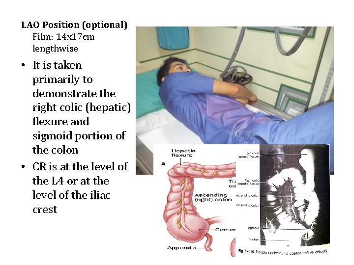 LAO Position (optional) Film: 14 x 17 cm lengthwise • It is taken primarily
