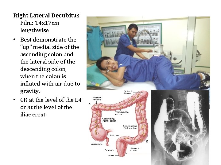 Right Lateral Decubitus Film: 14 x 17 cm lengthwise • Best demonstrate the “up”