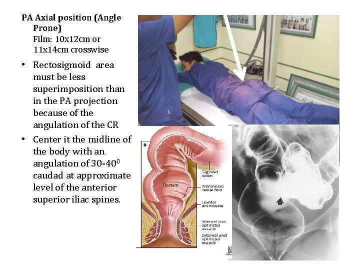 PA Axial position (Angle Prone) Film: 10 x 12 cm or 11 x 14