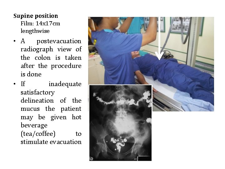 Supine position Film: 14 x 17 cm lengthwise • A postevacuation radiograph view of