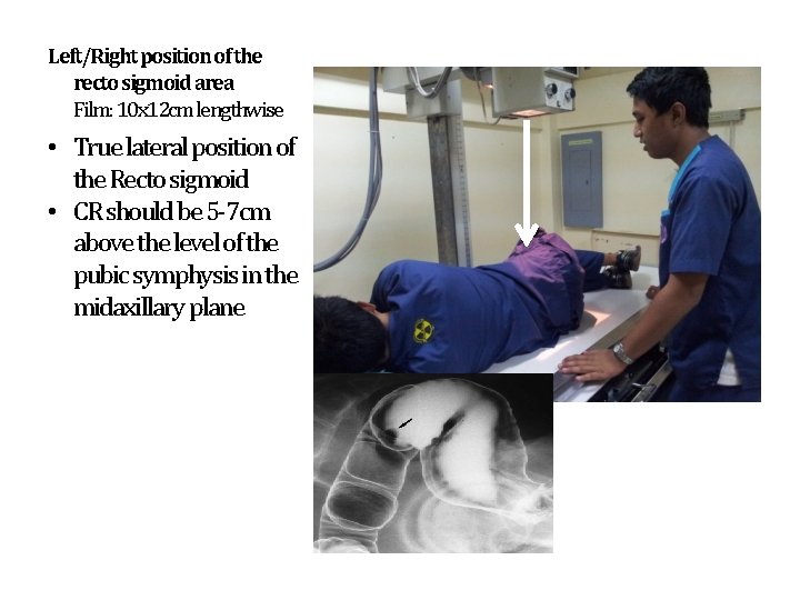 Left/Right position of the recto sigmoid area Film: 10 x 12 cm lengthwise •