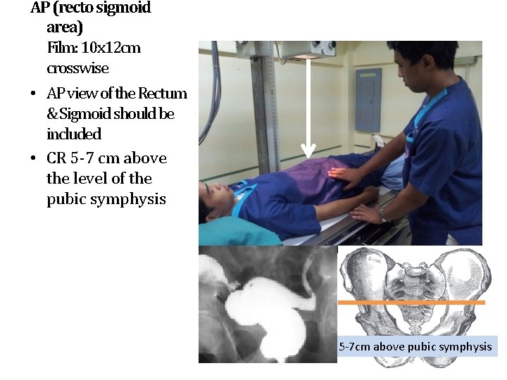 AP (recto sigmoid area) Film: 10 x 12 cm crosswise • AP view of