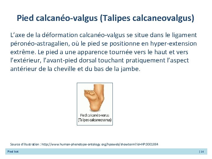 Pied calcanéo-valgus (Talipes calcaneovalgus) L’axe de la déformation calcanéo-valgus se situe dans le ligament