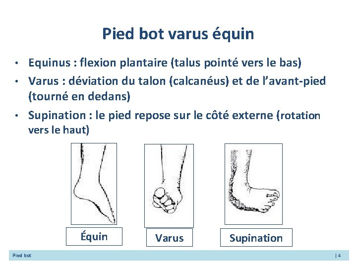 Pied bot varus équin • • • Equinus : flexion plantaire (talus pointé vers