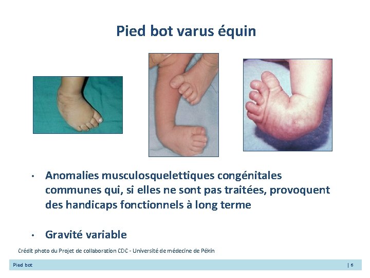 Pied bot varus équin • Anomalies musculosquelettiques congénitales communes qui, si elles ne sont