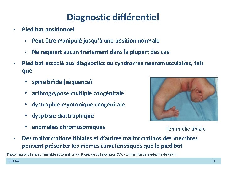Diagnostic différentiel • • Pied bot positionnel • Peut être manipulé jusqu’à une position