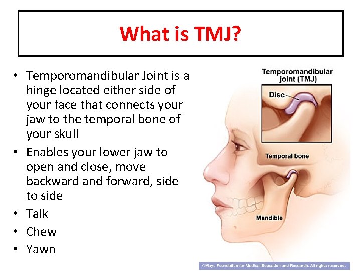 What is TMJ? • Temporomandibular Joint is a hinge located either side of your