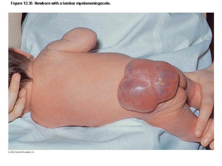 Figure 12. 35 Newborn with a lumbar myelomeningocele. 