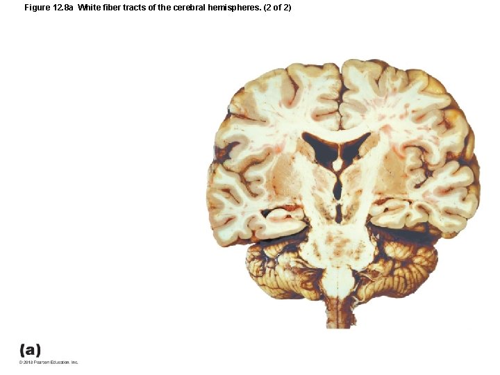 Figure 12. 8 a White fiber tracts of the cerebral hemispheres. (2 of 2)