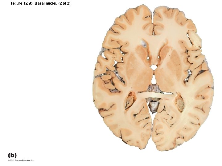 Figure 12. 9 b Basal nuclei. (2 of 2) 