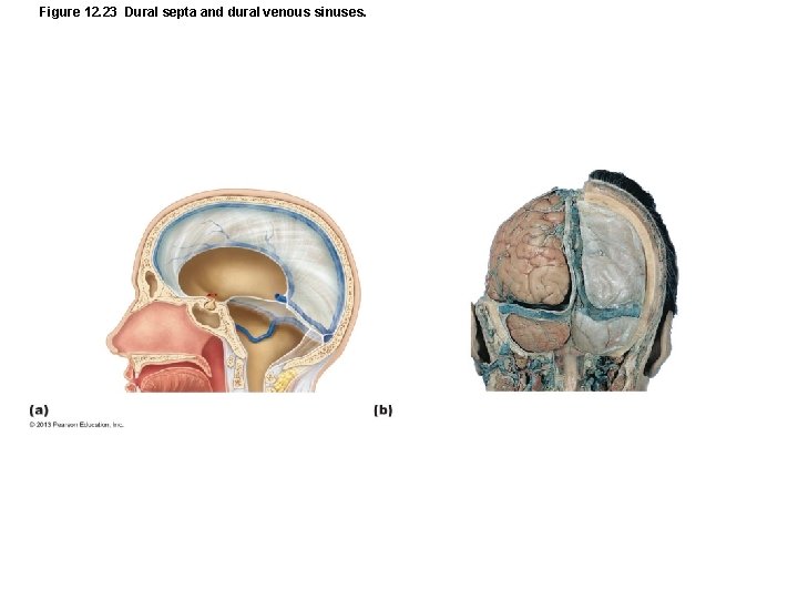 Figure 12. 23 Dural septa and dural venous sinuses. 