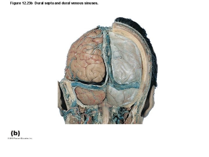 Figure 12. 23 b Dural septa and dural venous sinuses. 