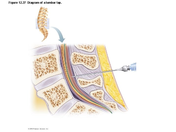 Figure 12. 27 Diagram of a lumbar tap. 