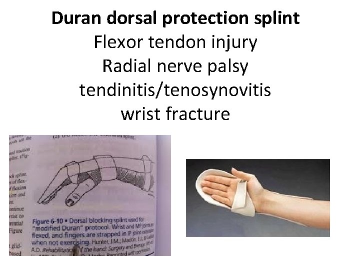 Duran dorsal protection splint Flexor tendon injury Radial nerve palsy tendinitis/tenosynovitis wrist fracture 