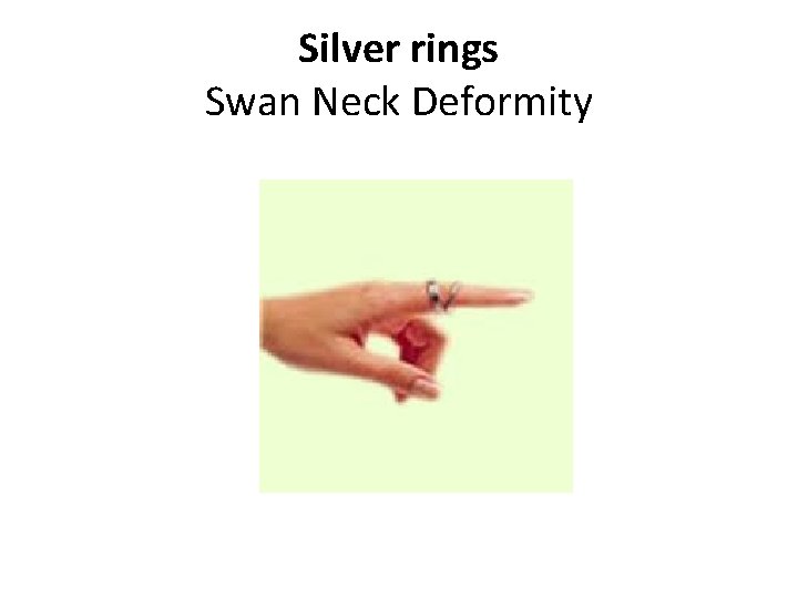 Silver rings Swan Neck Deformity 