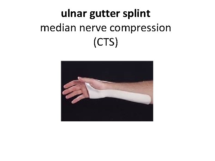 ulnar gutter splint median nerve compression (CTS) 