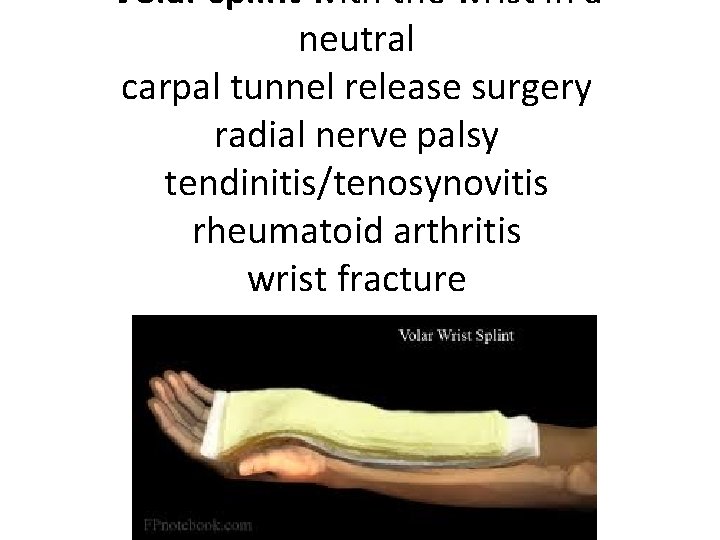 Volar splint with the wrist in a neutral carpal tunnel release surgery radial nerve