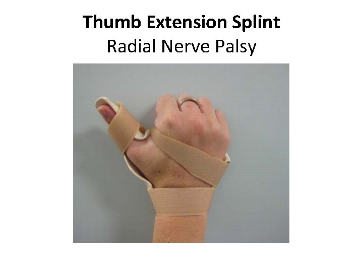 Thumb Extension Splint Radial Nerve Palsy 