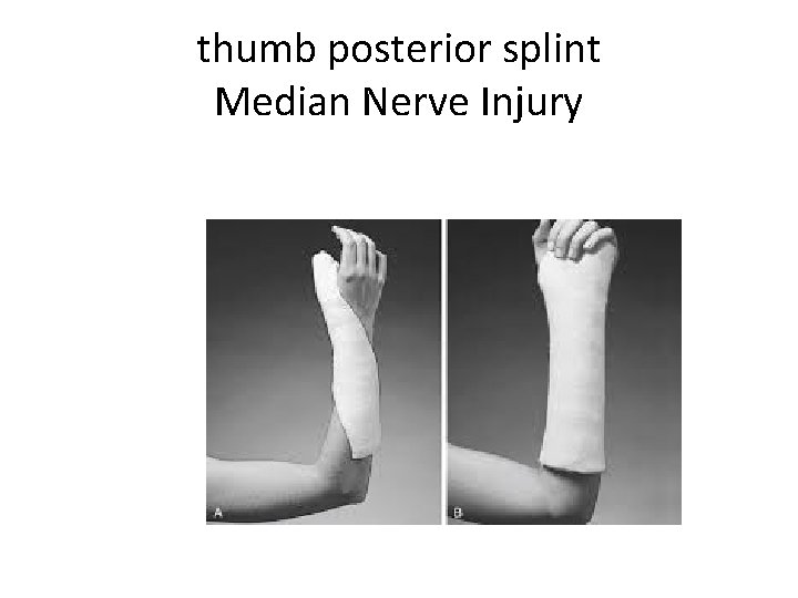 thumb posterior splint Median Nerve Injury 