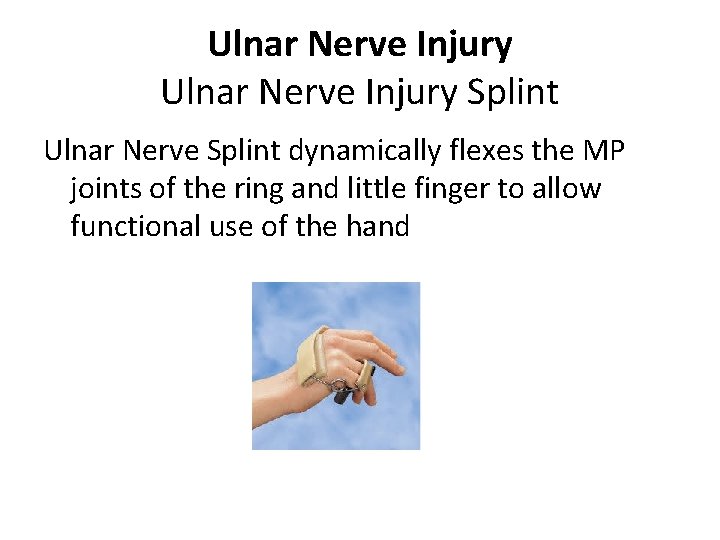 Ulnar Nerve Injury Splint Ulnar Nerve Splint dynamically flexes the MP joints of the