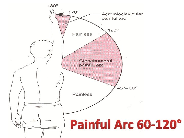 Painful Arc 60 -120° 