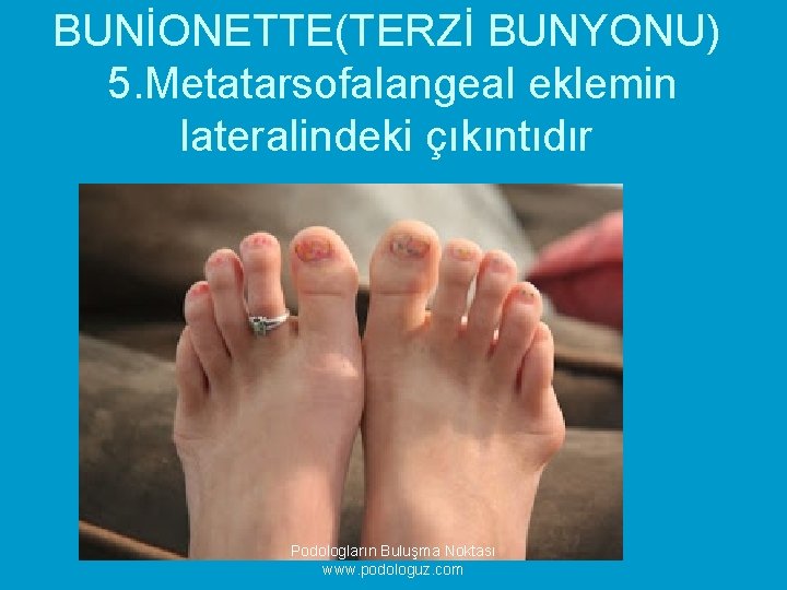 BUNİONETTE(TERZİ BUNYONU) 5. Metatarsofalangeal eklemin lateralindeki çıkıntıdır Podologların Buluşma Noktası www. podologuz. com 