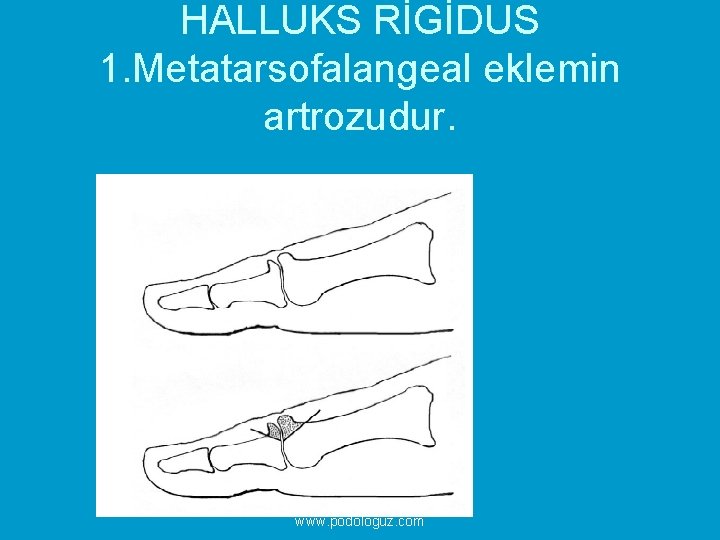 HALLUKS RİGİDUS 1. Metatarsofalangeal eklemin artrozudur. Podologların Buluşma Noktası www. podologuz. com 