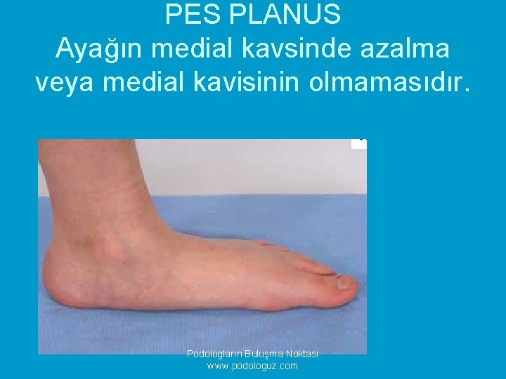 PES PLANUS Ayağın medial kavsinde azalma veya medial kavisinin olmamasıdır. Podologların Buluşma Noktası www.