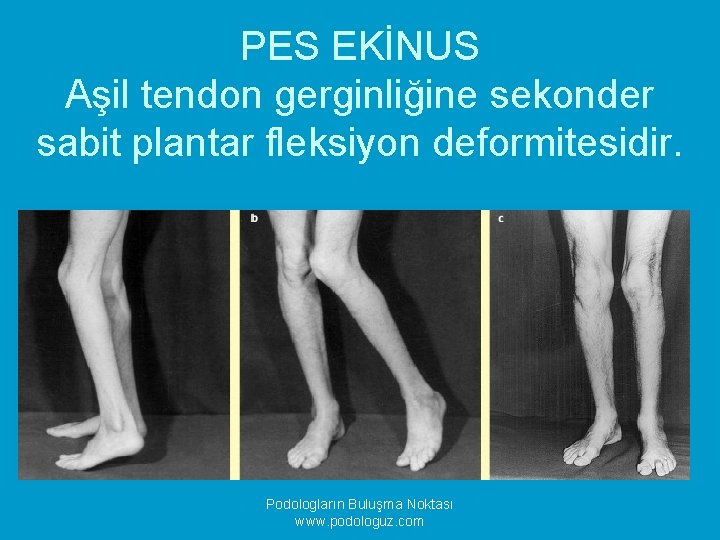 PES EKİNUS Aşil tendon gerginliğine sekonder sabit plantar fleksiyon deformitesidir. Podologların Buluşma Noktası www.