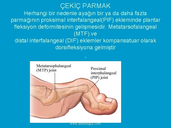 ÇEKİÇ PARMAK Herhangi bir nedenle ayağın bir ya da daha fazla parmağının proksimal interfalangeal(PIF)