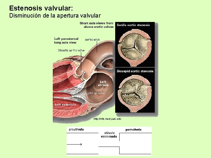 Estenosis valvular: Disminución de la apertura valvular http: //info. med. yale. edu 