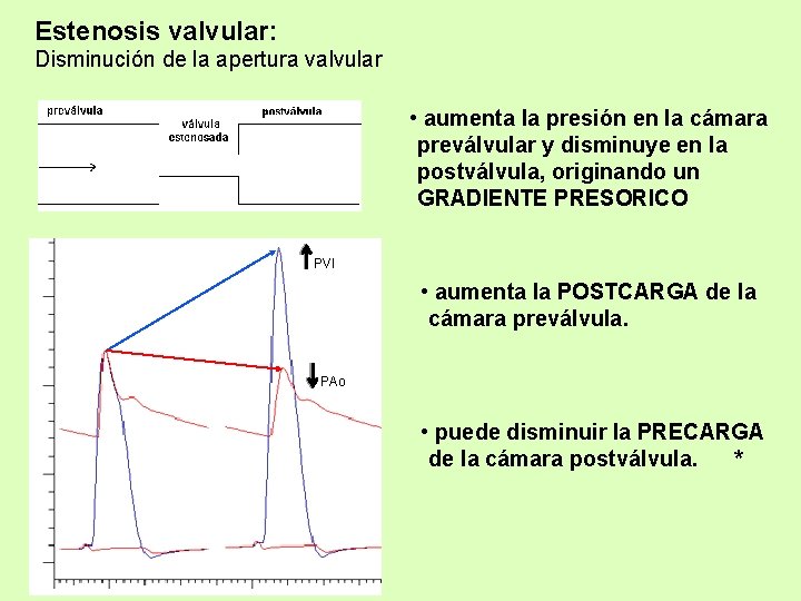 Estenosis valvular: Disminución de la apertura valvular • aumenta la presión en la cámara